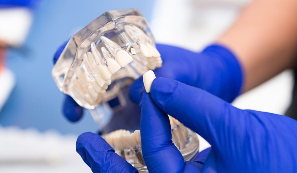 Dental Implants Ibbott&Co