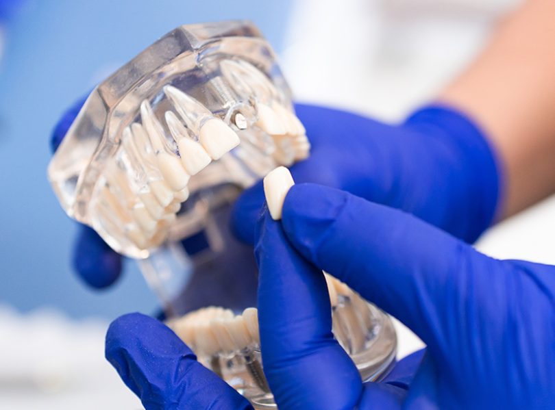 Dental Implants Ibbott&Co