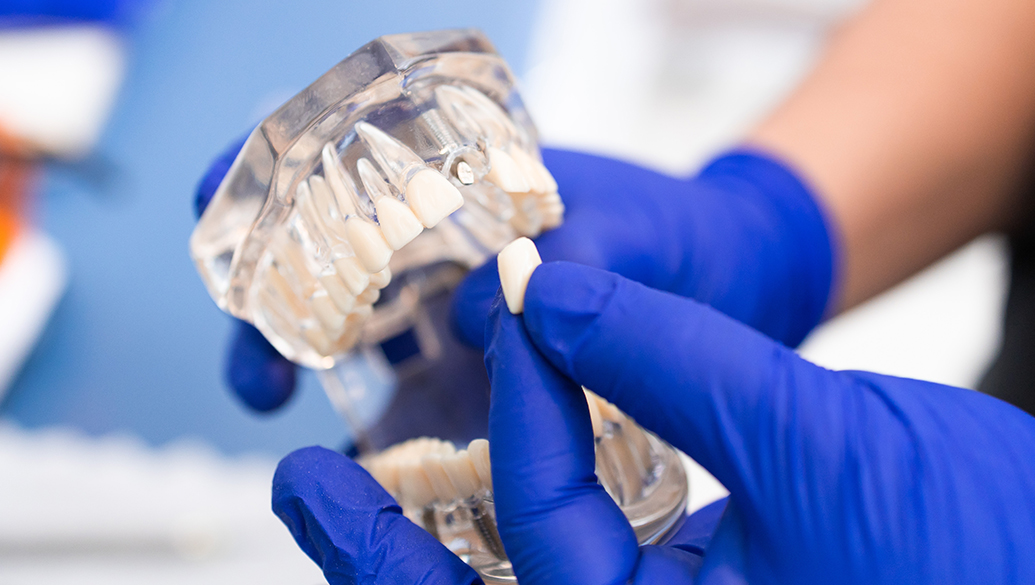 Dental Implants Tunbridge Wells