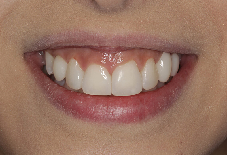 After - Ibbott Dental