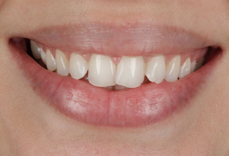 Before - Ibbott Dental