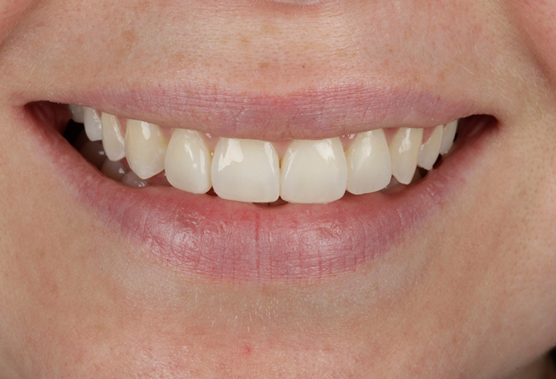 After - Ibbott Dental