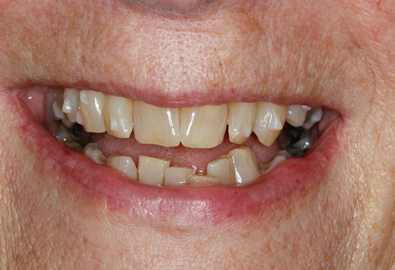 Before - Ibbott Dental