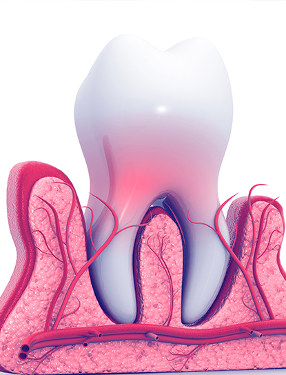 Endodontic Treatment