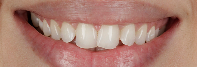 Before - Ibbott Dental