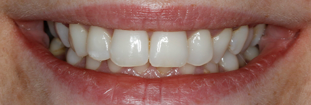 Before - Ibbott Dental