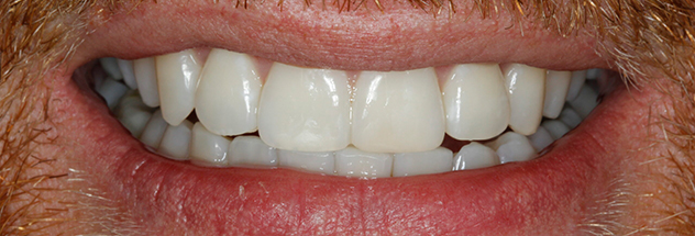 After - Ibbott Dental 