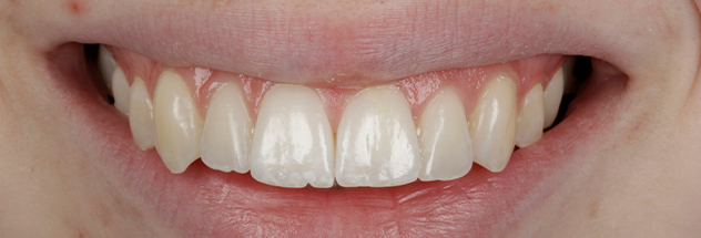 After - Ibbott Dental 