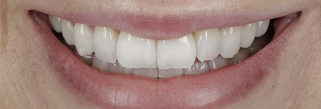 After - Ibbott Dental 