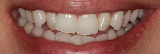 Before - Ibbott Dental