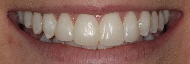 After - Ibbott Dental 