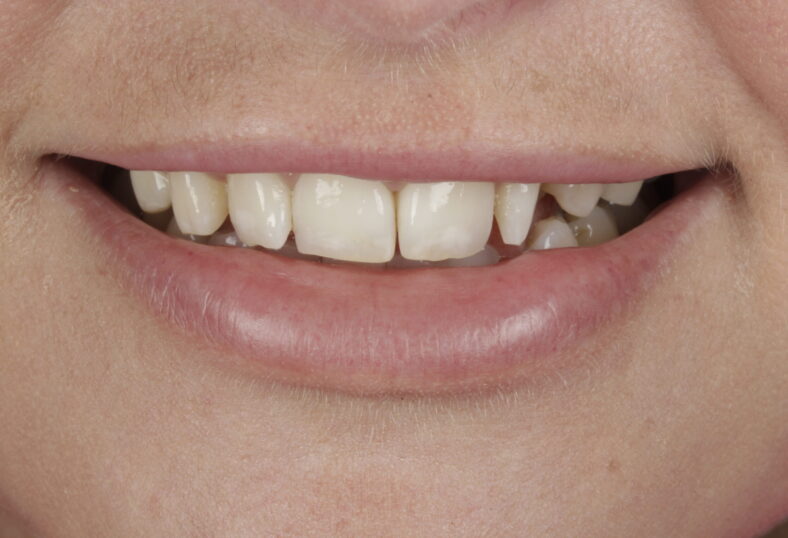 Before - Ibbott Dental