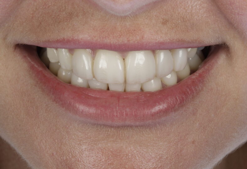 After - Ibbott Dental