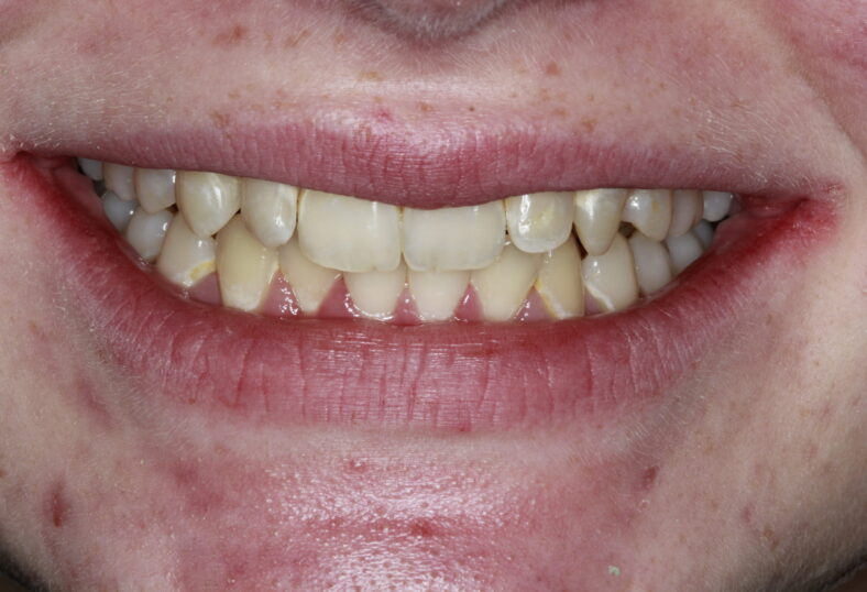 Before - Ibbott Dental