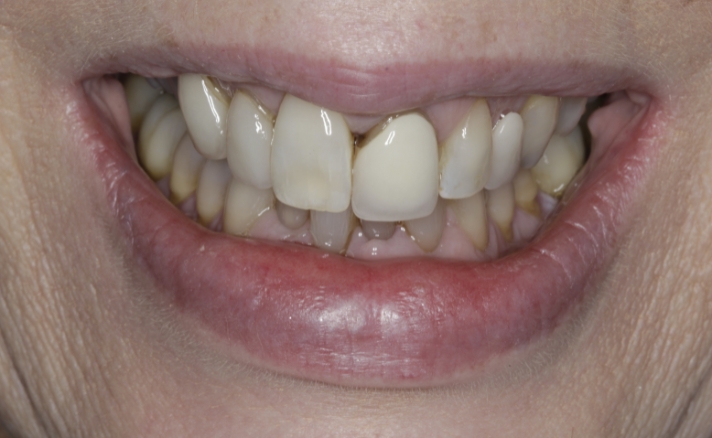 Porcelain Veneers