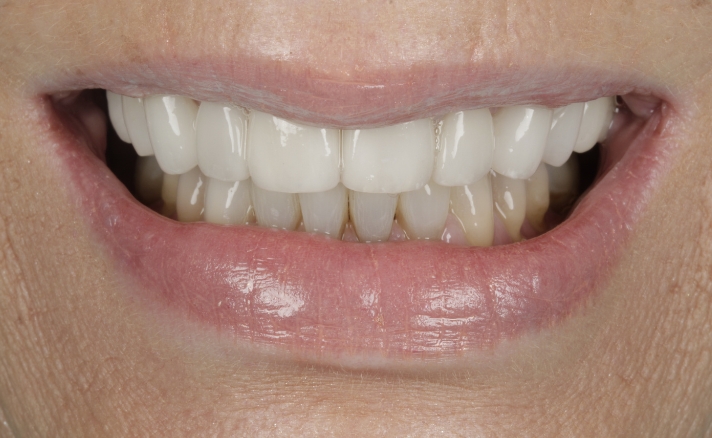 Porcelain Veneers