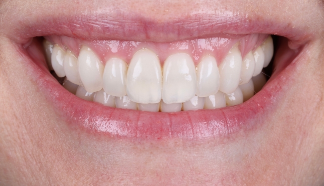 Invisalign®
