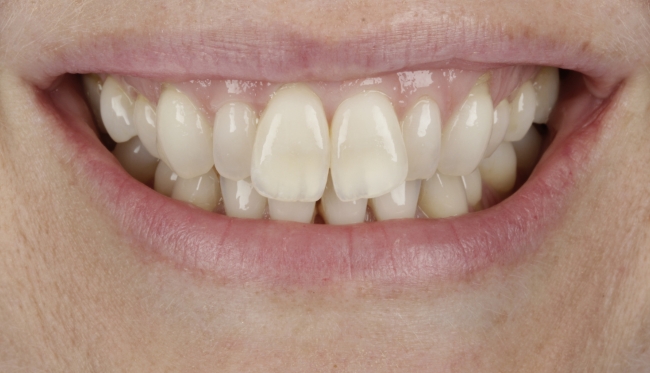Invisalign®