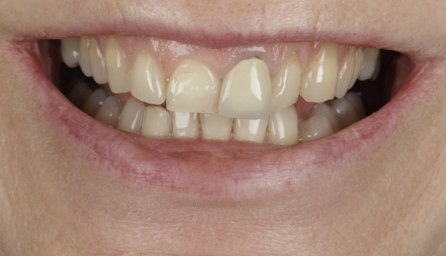 Veneers