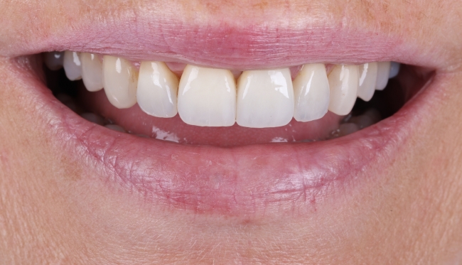 Veneers