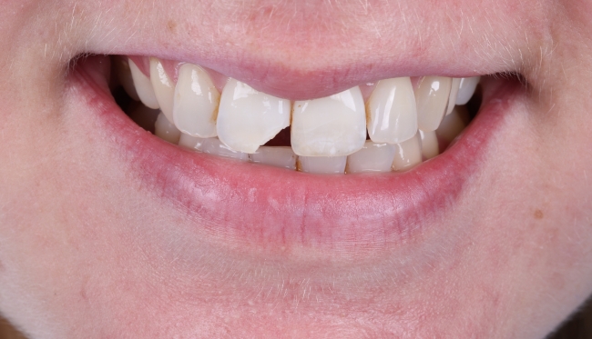 Composite Bonding