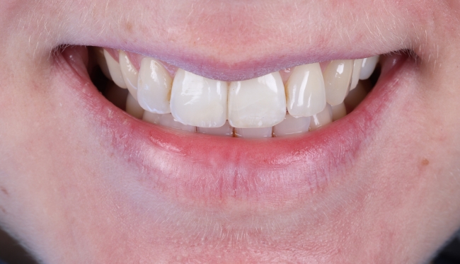 Composite Bonding