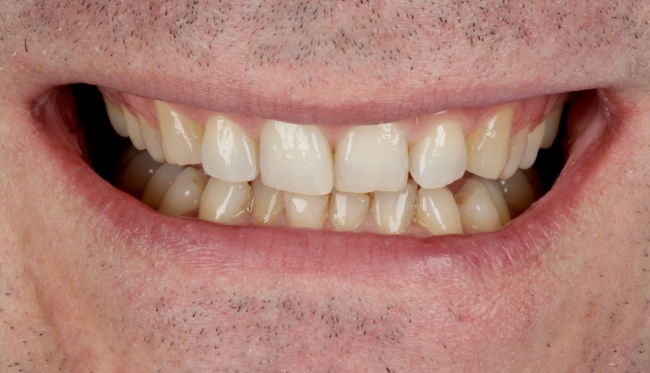Invisalign and whitening