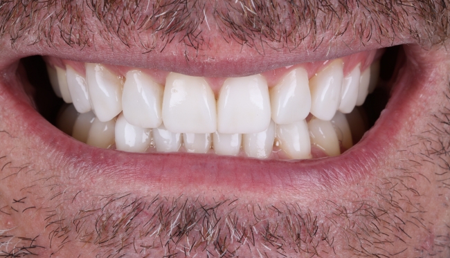 Invisalign and whitening