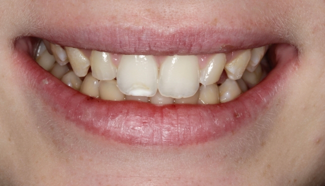 Bonding and whitening