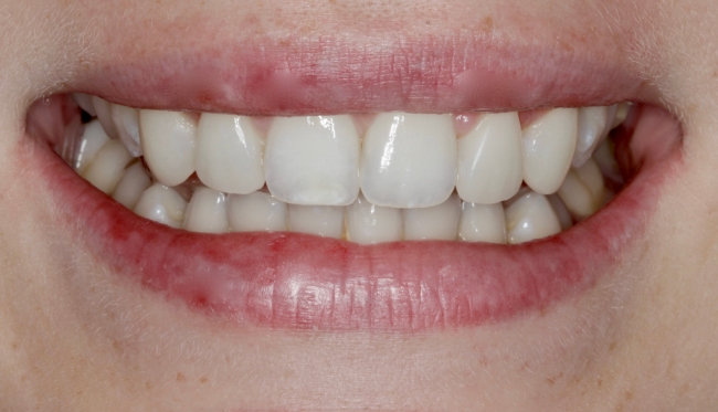 Bonding and whitening