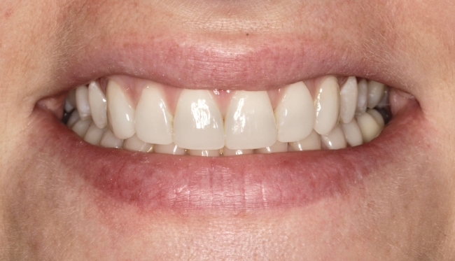 Composite Bonding