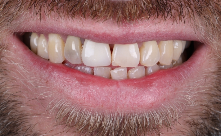 Teeth Whitening before