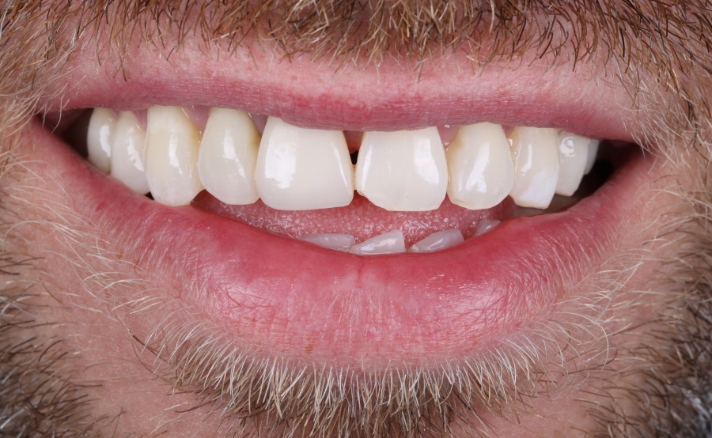 Teeth Whitening after