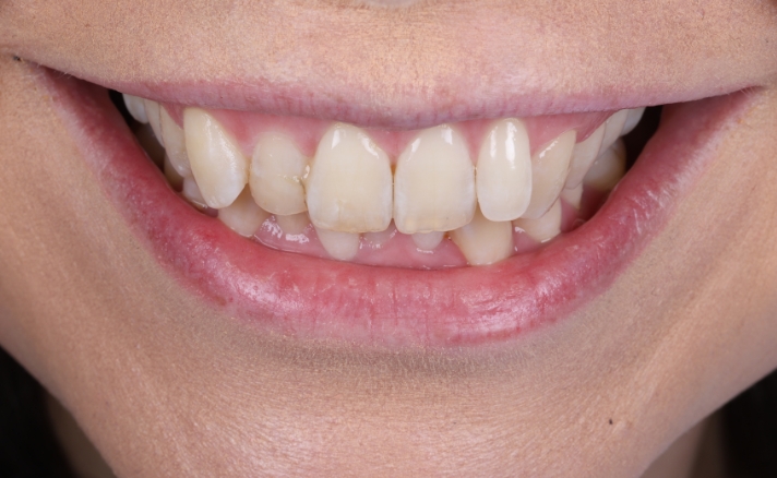 Teeth Whitening before