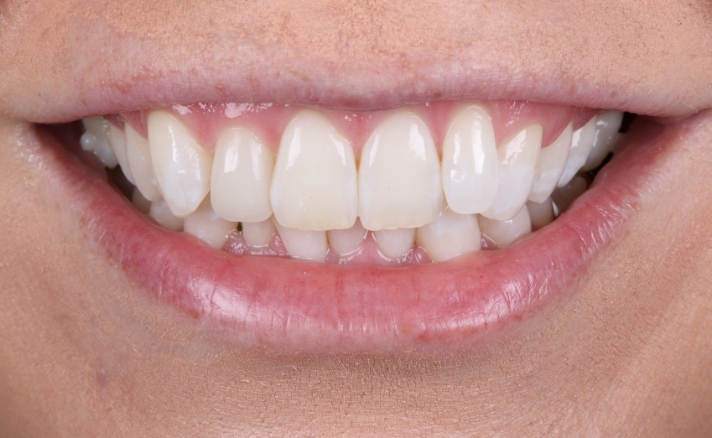Teeth Whitening after