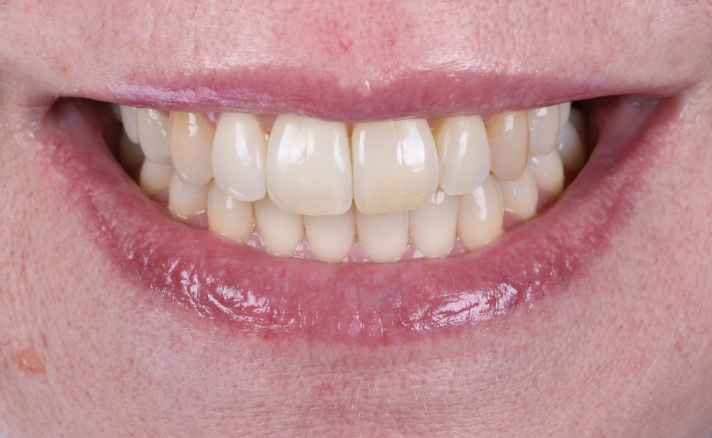 Teeth Whitening before