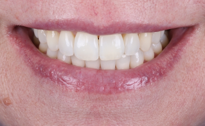 Teeth Whitening after