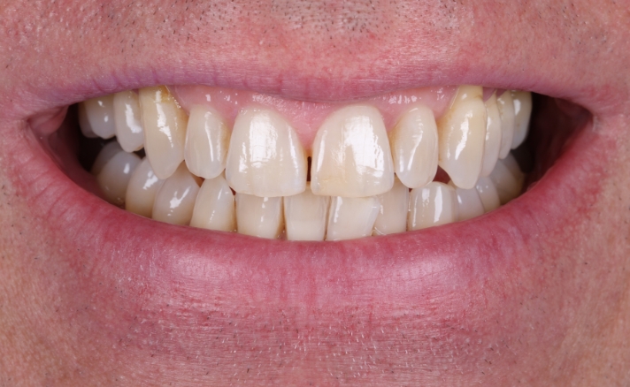 Teeth Whitening before