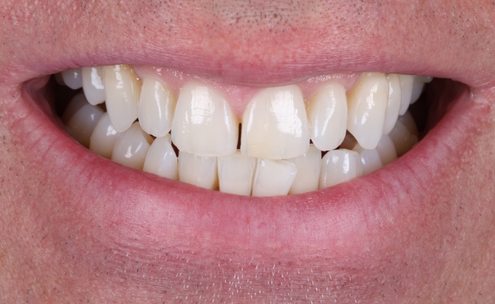 Teeth Whitening after