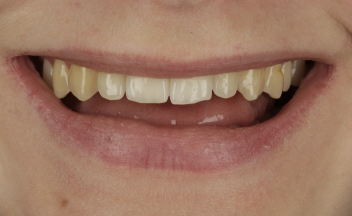 Composite Veneers