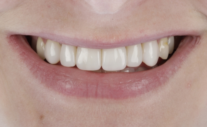 Composite Veneers