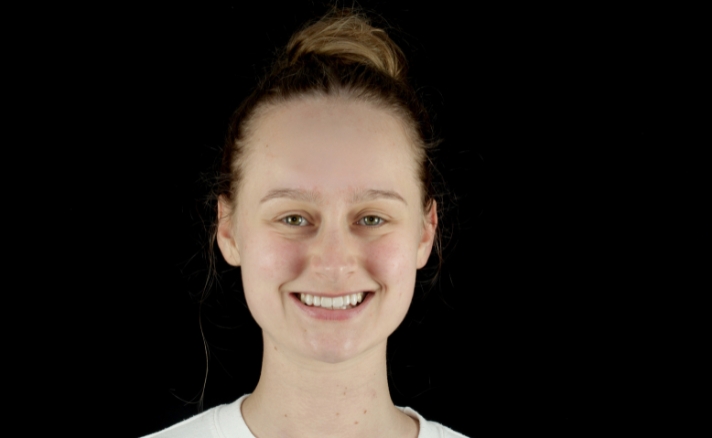 Composite Veneers