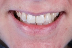Ibbott&Co Case Study: Repairing a chipped front tooth - AFTER