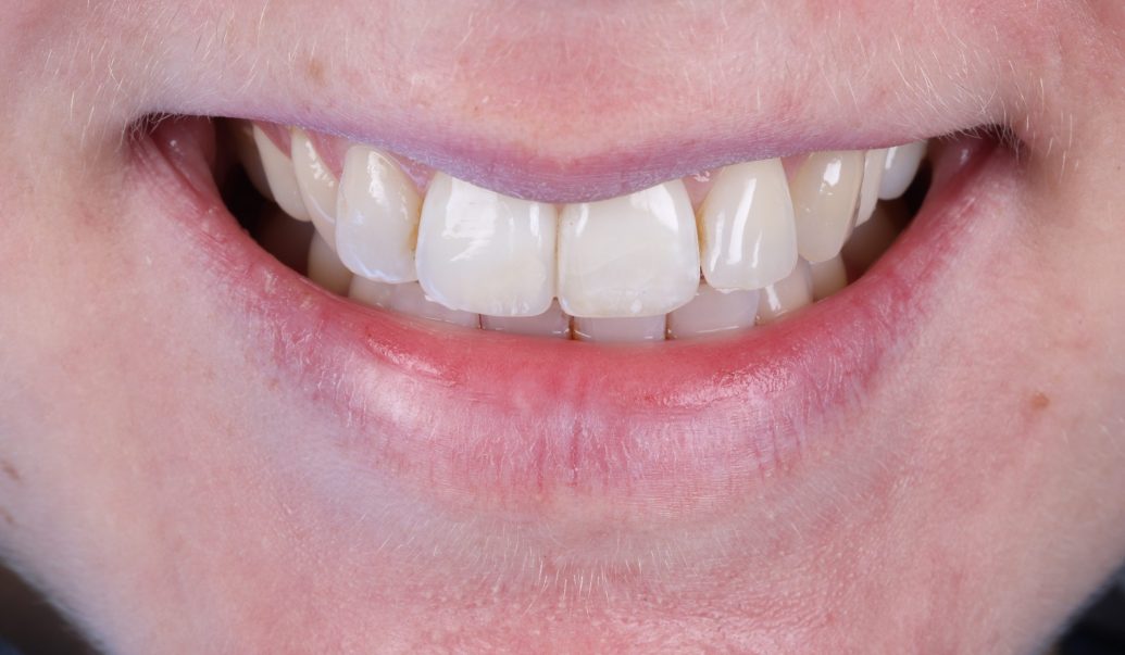 Ibbott&Co Case Study: Repairing a chipped front tooth - AFTER