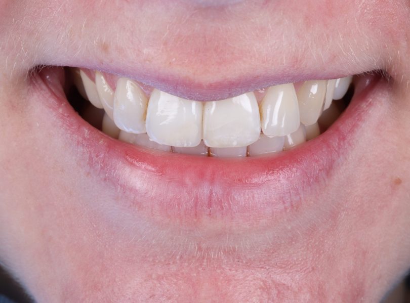 Ibbott&Co Case Study: Repairing a chipped front tooth - AFTER