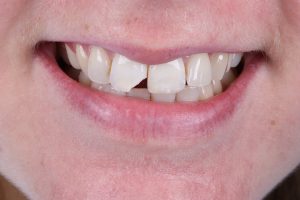 Ibbott&Co Case Study: Repairing a chipped front tooth - BEFORE