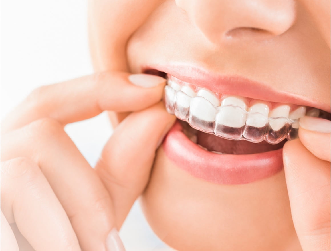 Smiling patient inserting Invisalign clear braces
